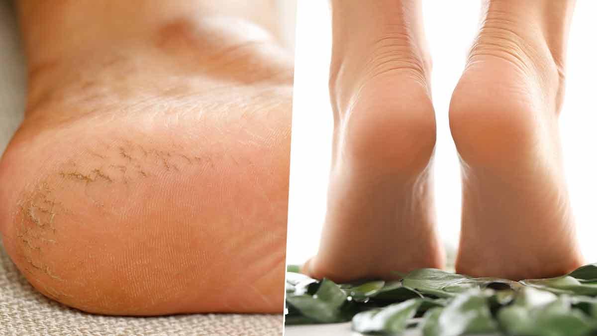 फटी एड़ियों से छुटकारा पाने के 5 घरेलू उपाय, केला-शहद से लेकर वैसलीन तक आएंगे काम